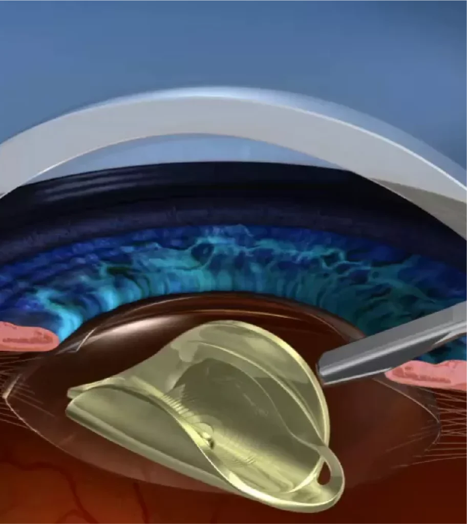 ชนิดของ เลนส์ตาเทียม (Intraocular Lens: IOL)